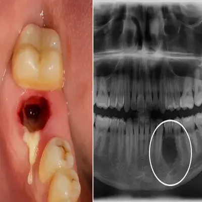 حفره دندان ملتهب با ترشح چرک و خونریزی