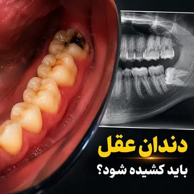 دندان عقل را بکشیم یا نه