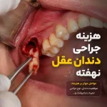 هزینه جراحی و کشیدن دندان عقل ۱۴۰۵ - قیمت انواع نهفتگی
