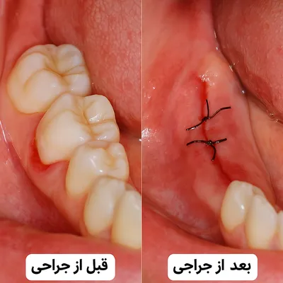 تصویر قبل و بعد جراحی دندان نهفته همراه با بخیه و بهبود لثه