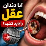 آیا دندان عقل را باید کشید؟
