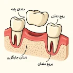 بریج دندان چیست؟