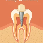 پست دندان چیست؟