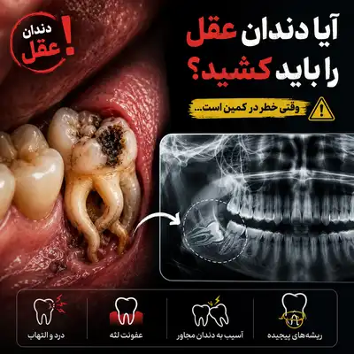 چرا دندان عقل را باید کشید؟