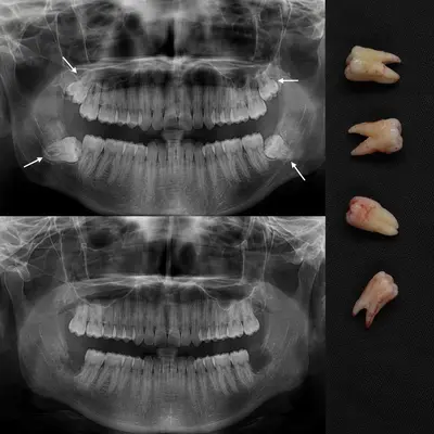 عکس OPG چهار دندان عقل نهفته پیش از جراحی
