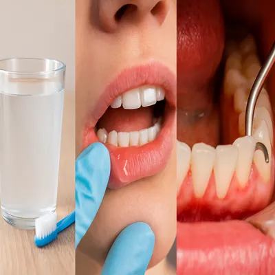 آب نمک برای التهاب لثه، ژل موضعی روی لثه ملتهب، جرمگیری حرفهای دندان