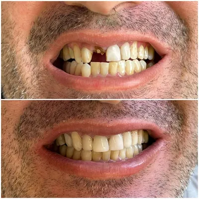 قبل و بعد بازسازی فک بالا با دندانهای جدید و طبیعی