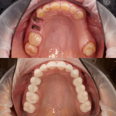 تغییر چشمگیر لبخند پس از ترمیم کامل و اصلاح طرح لبخند