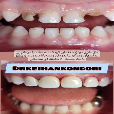 دندانپزشکی تحت بیهوشی کودکان