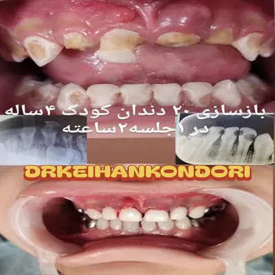 آرامبخشی در دندانپزشکی کودکان