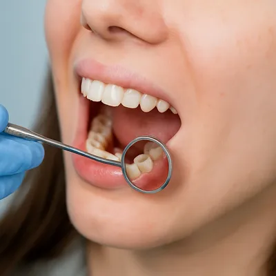 نمای واقعی معاینه مولر سوم با آینه دندانپزشکی