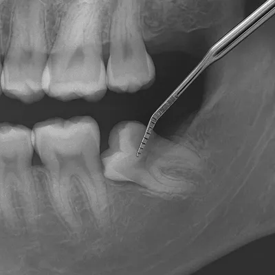 رادیوگرافی دقیق مولر سوم نهفته با پروب دندانپزشکی