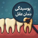 پوسیدگی دندان عقل