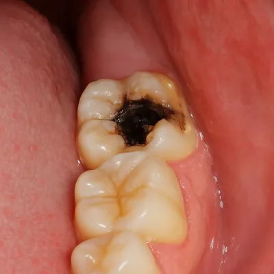 دندان انتهایی فک با خرابی شدید و التهاب لثه