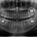 دندان عقل شماره چند است؟