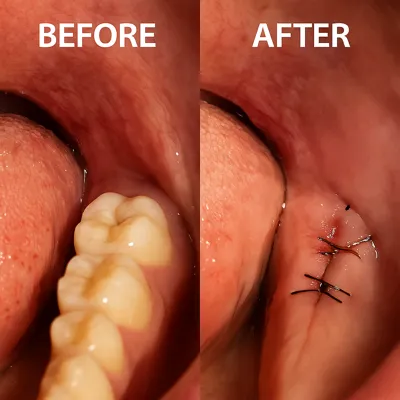 قبل و بعد جراحی دندان با بخیه و التهاب لثه