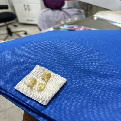 تفاوت سختی کشیدن دندان عقل بالا و پایین