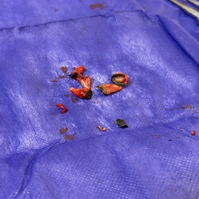 عوامل مؤثر بر راحتی یا سختی کشیدن دندان عقل