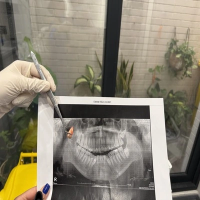 مقایسه درد و نقاهت بعد از کشیدن دندان عقل بالا و پایین