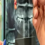 عوارض کشیدن دندان