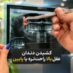 کشیدن دندان عقل بالا راحتتره یا پایین