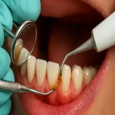 از بین بردن جرم سخت دندان با دستگاه اولتراسونیک