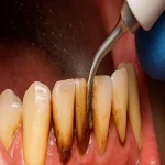آیا برای جرم‌گیری دندان بی‌حسی می‌زنند؟