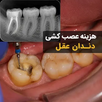 هزینه عصب‌کشی دندان عقل