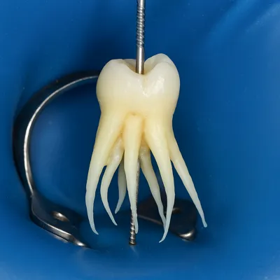 درمان ریشه دشوار دندان با کانالهای متعدد و پیچیده