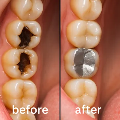 ترمیم دندان با آمالگام و رفع پوسیدگی عمیق