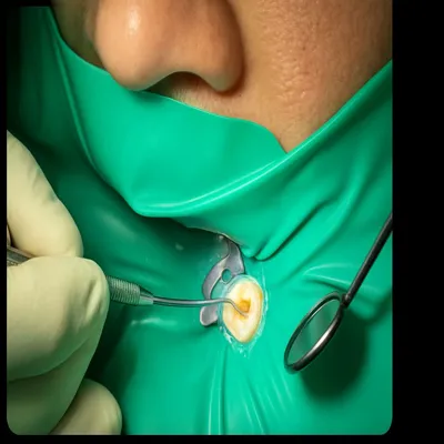 پاکسازی کانال ریشه دندان زیر میکروسکوپ دندانپزشکی