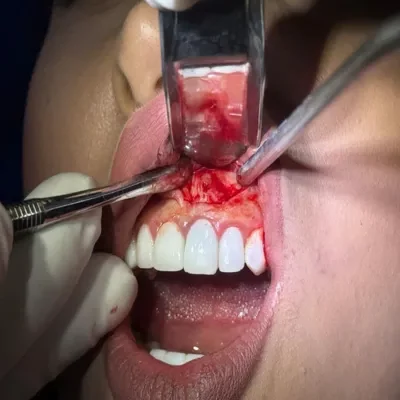 درمان جراحی ریشه دندان با دقت بالا