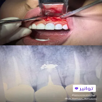 جراحی اپیکوکتومی دندان جلو و تصویر رادیوگرافی