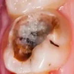 بعد از عصب‌کشی و پرکردن دندان چه باید کرد