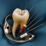 عصبکشی دندان عقل