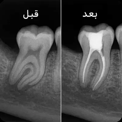 رادیوگرافی قبل و بعد از درمان ریشه دندان با ریشه‌های پیچیده