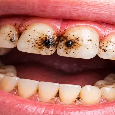 لکه و رنگدانههای سیاه سطحی روی دندانهای جلو