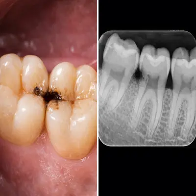 پوسیدگی بیندندانی دندان آسیاب همراه تصویر بایتوینگ