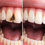 ترمیم دندان سیاه شده جلو