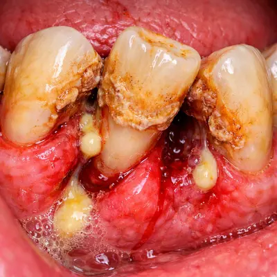 آیا دندان لق سفت میشود