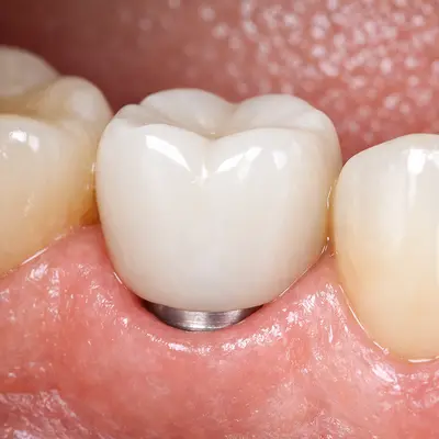 ایمپلنت دندان با لثه سالم و تمیز، بدون التهاب و خونریزی