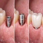 ایمپلنت بدون درد و خونریزی