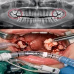 آیا جراحی دندان عقل بیهوشی دارد؟
