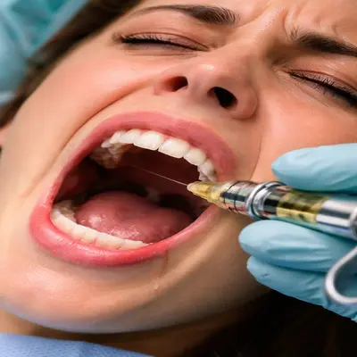 تزریق بیحسی دندان با سوزن و واکنش دردناک لثه