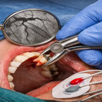 کشیدن دندان بیمار قلبی با پایش ضربان