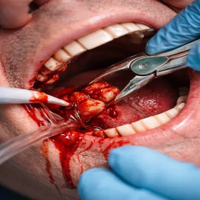 خونریزی شدید حین جراحی دندان و کنترل با ابزار دندان‌پزشکی