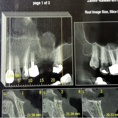 سینوس لیفت در دندانپزشکی