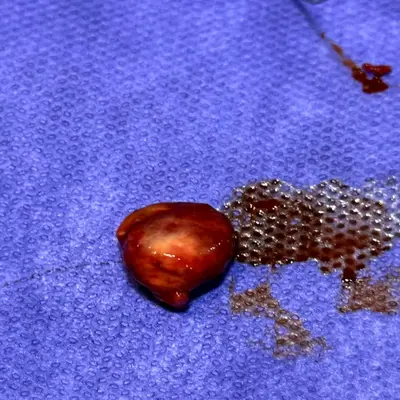 لیفت سینوس برای ایمپلنت