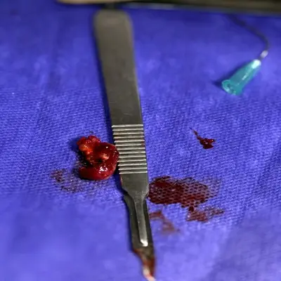 لیفت سینوس دندان