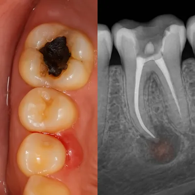 🔹 alt:عصبکشی ناقص دندان با آبسه چرکی و پوسیدگی؛ علت تیر کشیدن دندان با آب سرد